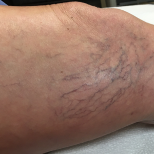 varicose bruise picioare unguent varicose vene recenzii